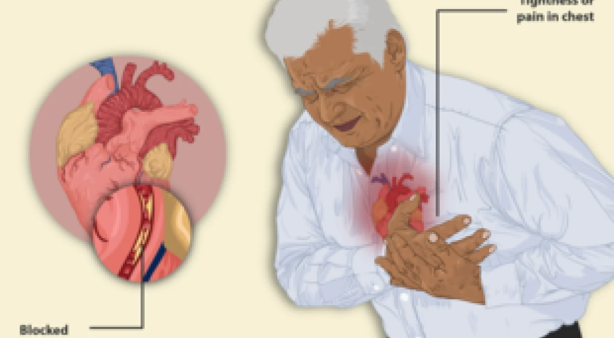 Стенокардия: что это такое и как правильно лечить