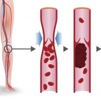 Deep vein thrombosis of the legs: causes and treatment