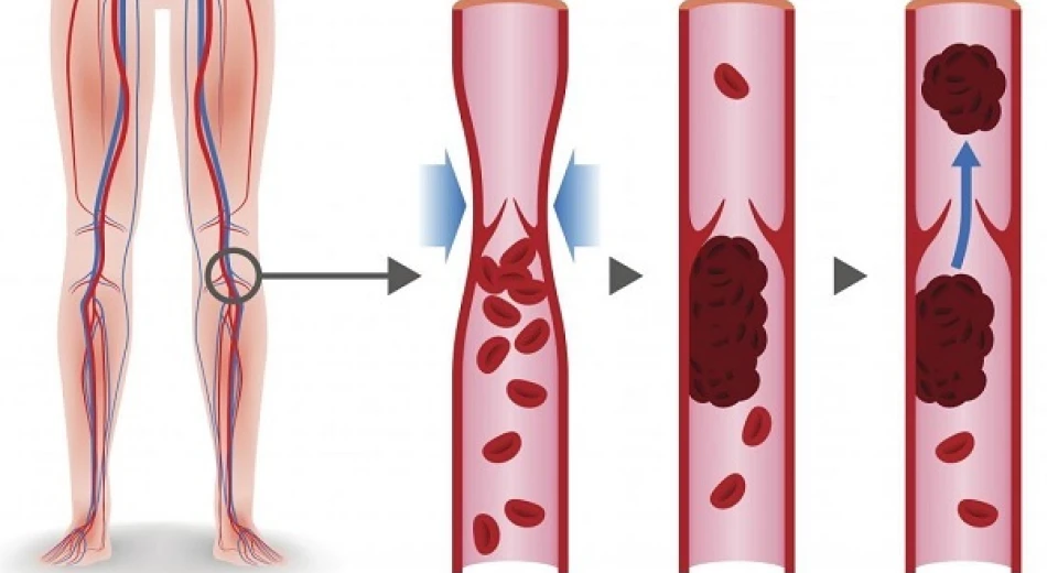 Тромбоз глибоких вен ніг: причини і лікування