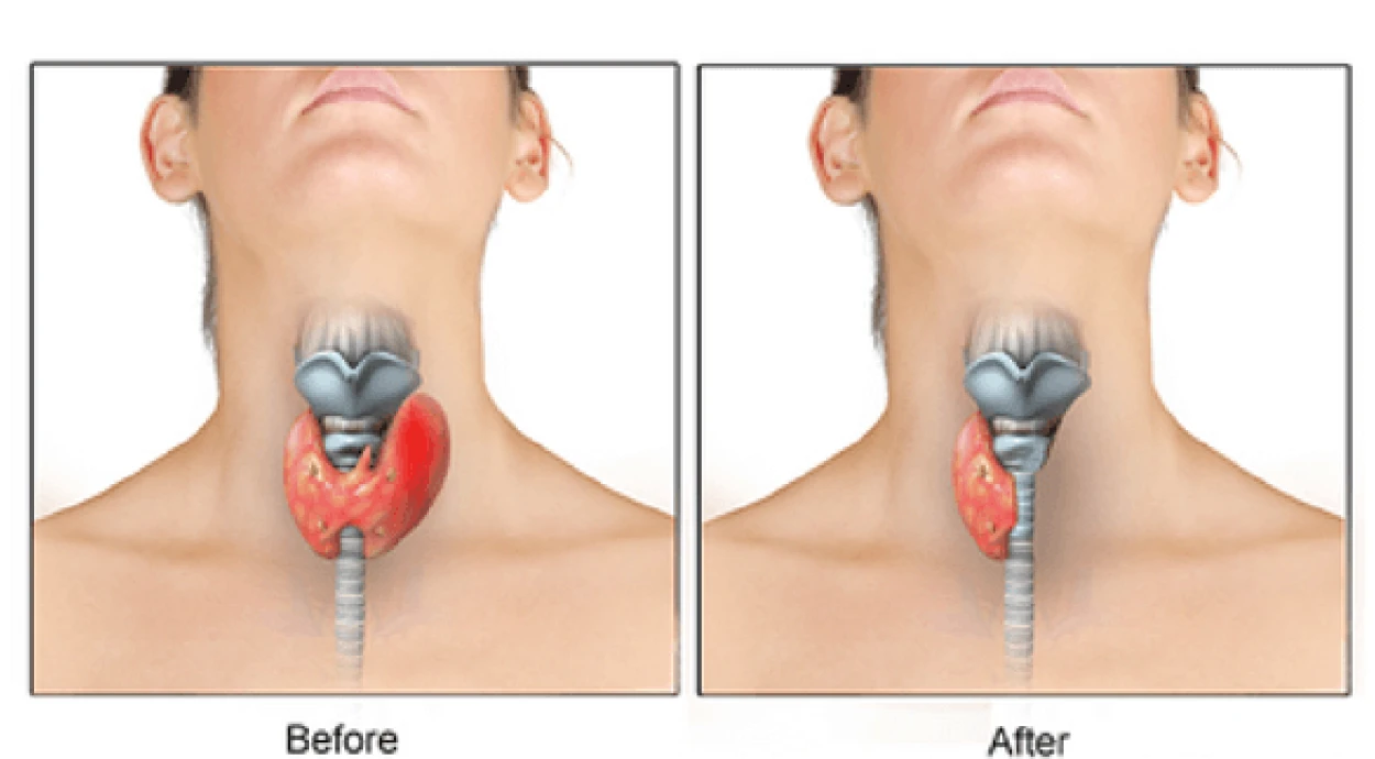 Удаление доли щитовидной железы (гемитиреоидэктомия)