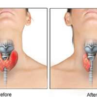 Удаление доли щитовидной железы (гемитиреоидэктомия)