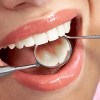 Удаление зубного камня