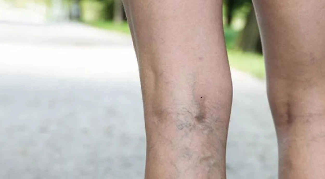 Варикозные узлы на ногах