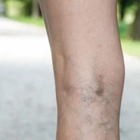 Варикозные узлы на ногах