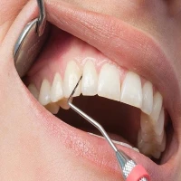 Вестибулопластика