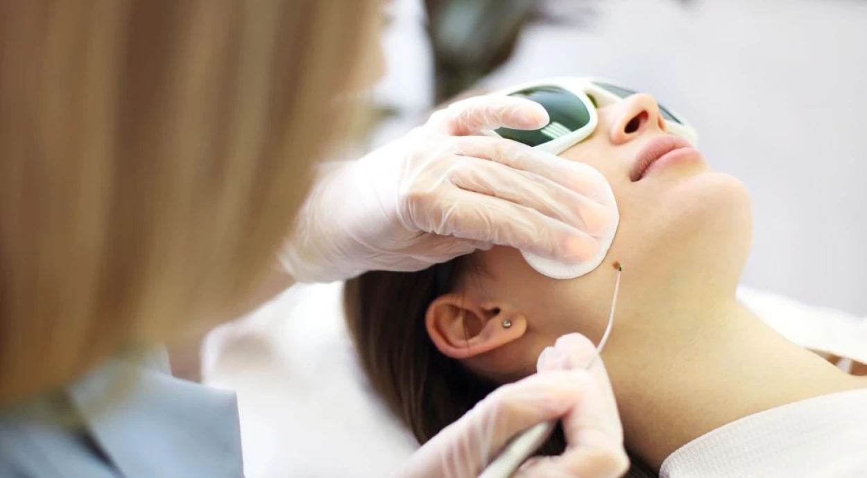 Removal of moles, warts and papillomas: when, who and how should it be done