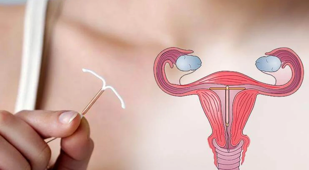 Внутриматочная спираль: все об этом методе контрацепции