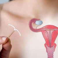 Внутриматочная спираль: все об этом методе контрацепции