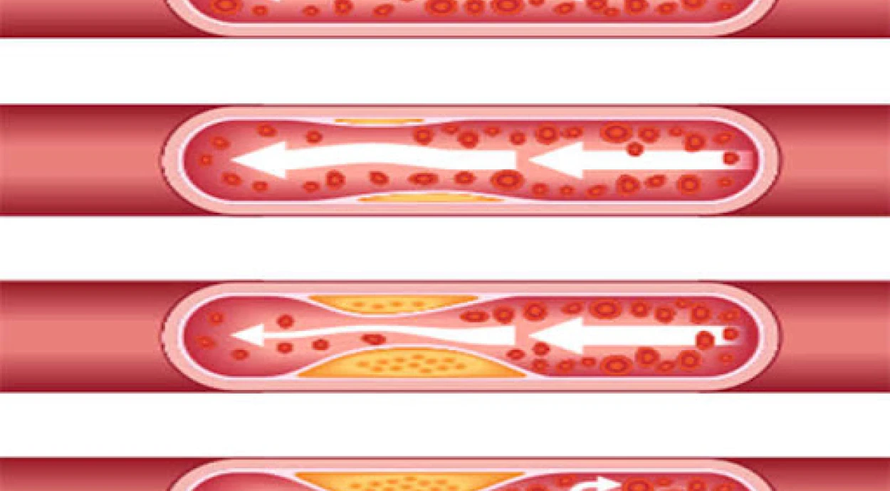 Высокий и низкий уровень холестерина: на что влияет и как нормализовать?