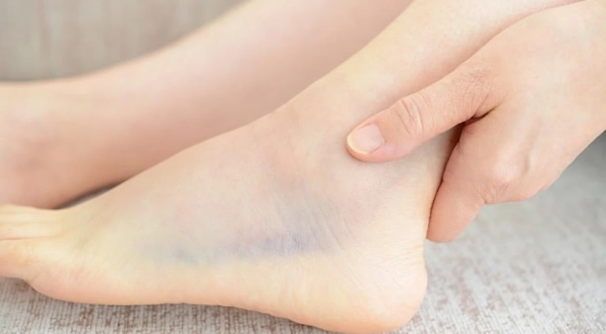 Вывихи стопы: виды, симптомы, первая помощь и лечение