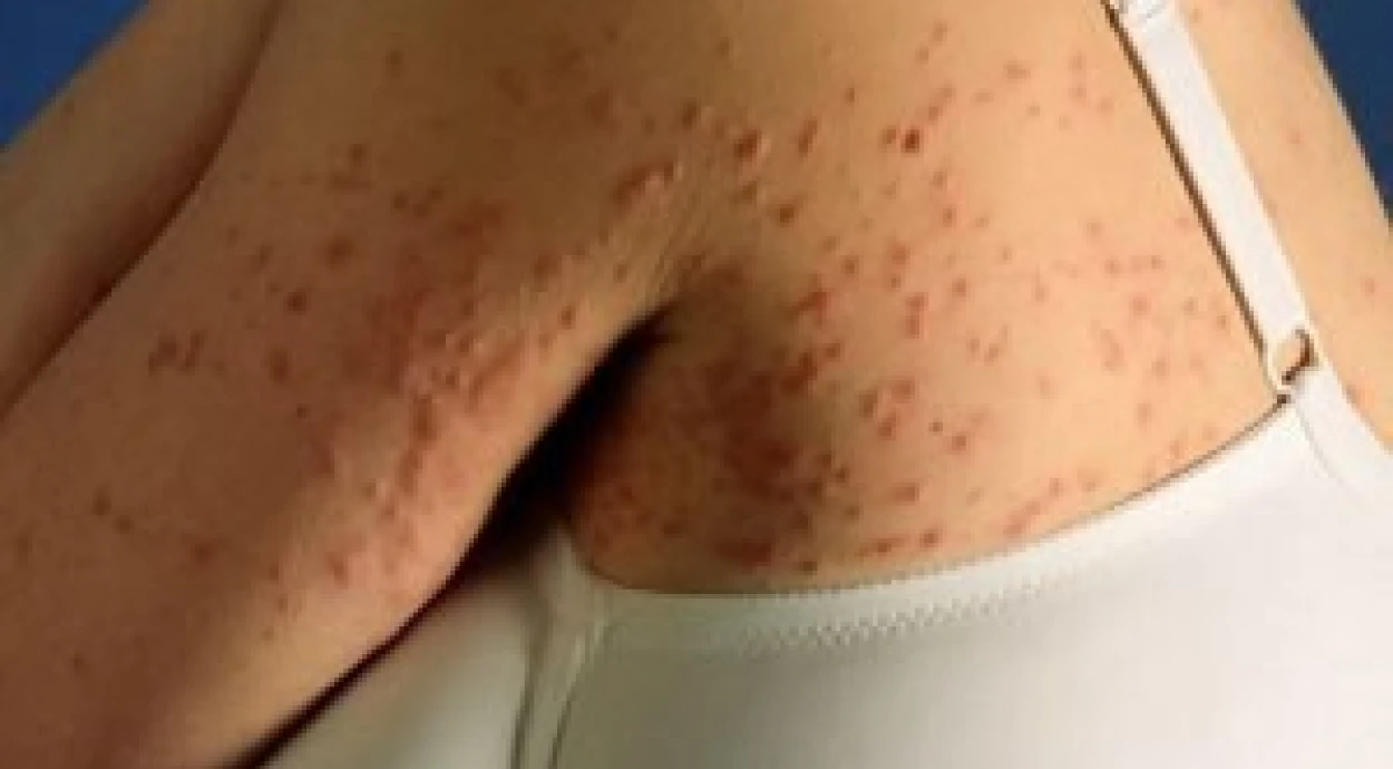 Взрослое пруриго (почесуха)