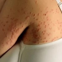 Взрослое пруриго (почесуха)