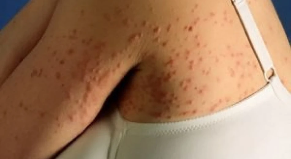 Доросле пруріго (почесуха)