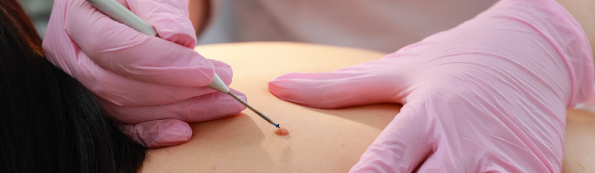 Видалення фіброми