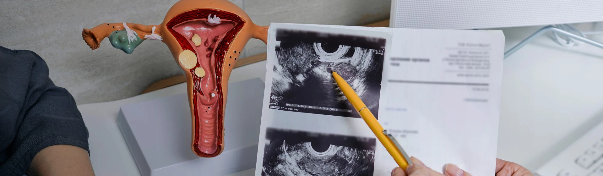 Эхогистеросальпингография (исследование проходимости маточных труб)