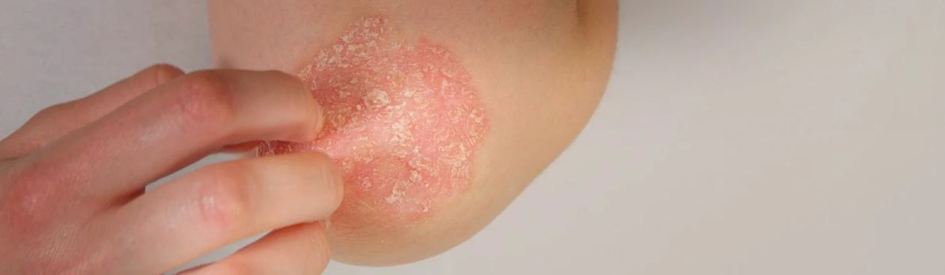 Лечение экземы в частной клинике Оксфорд Медикал Киев