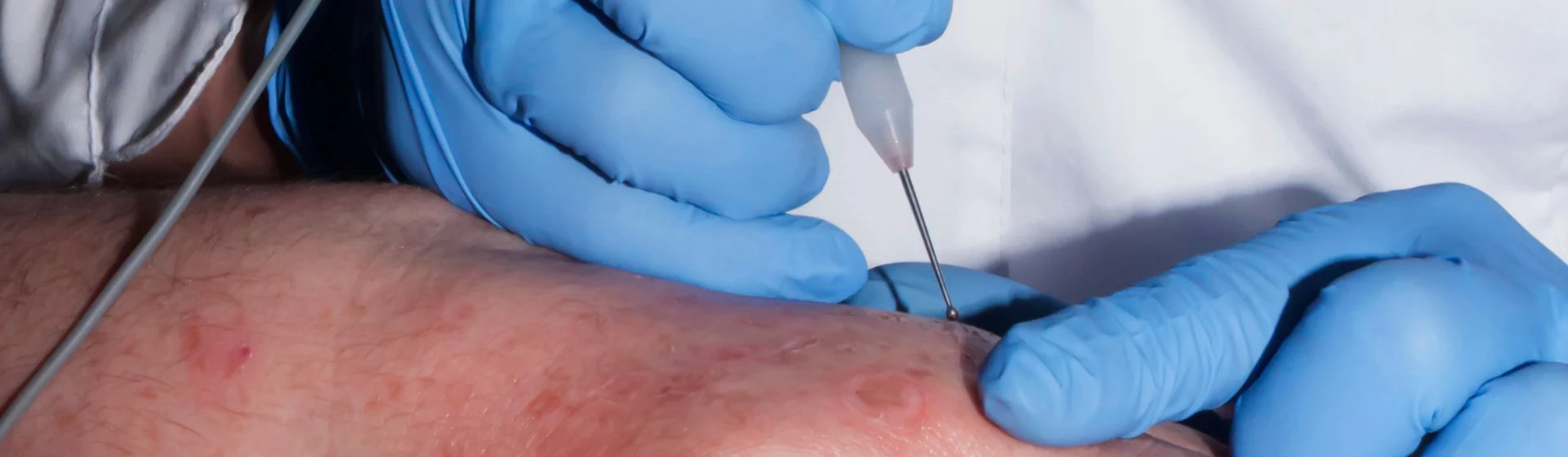 Удаление папиллом в частной клинике Оксфорд Медикал Киев