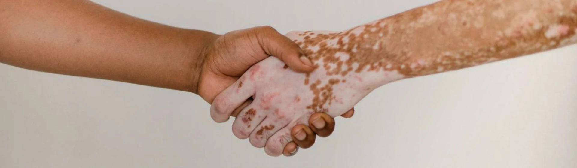 Vitiligo treatment at Oxford Medical Kiev private clinic