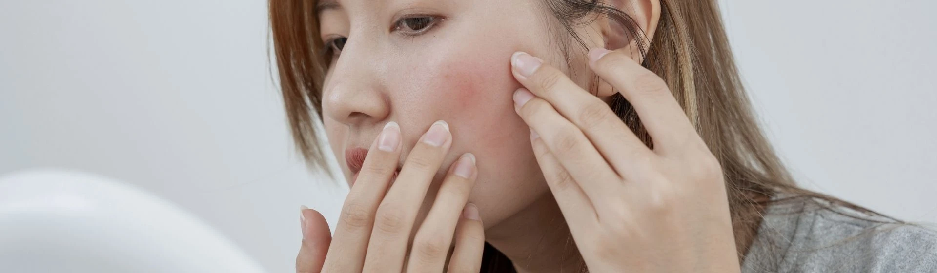 Treatment of rosacea (pink acne) at the Oxford Medical Kiev private clinic