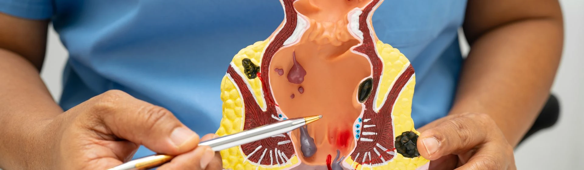 Treatment of anal fissures in the private clinic Oxford Medical Kyiv