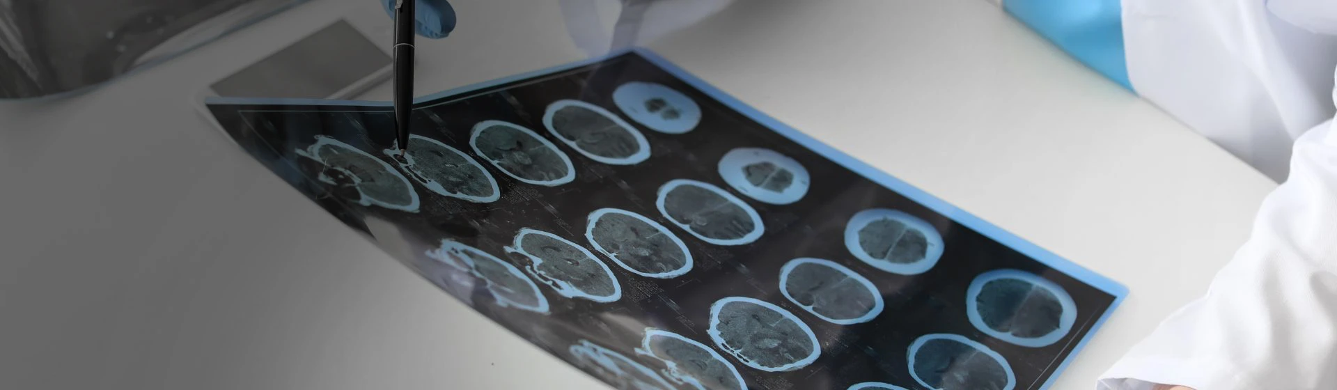 Лечение эпилепсии в частной клинике Оксфорд Медикал Киев