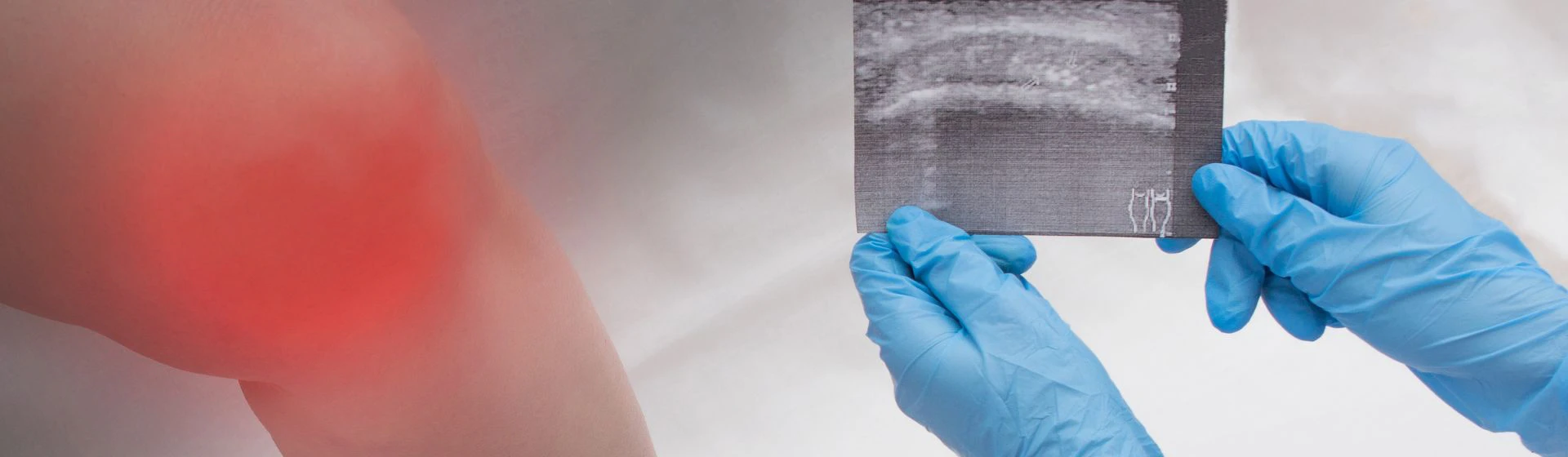 Лечение артрита в частной клинике Оксфорд Медикал Киев