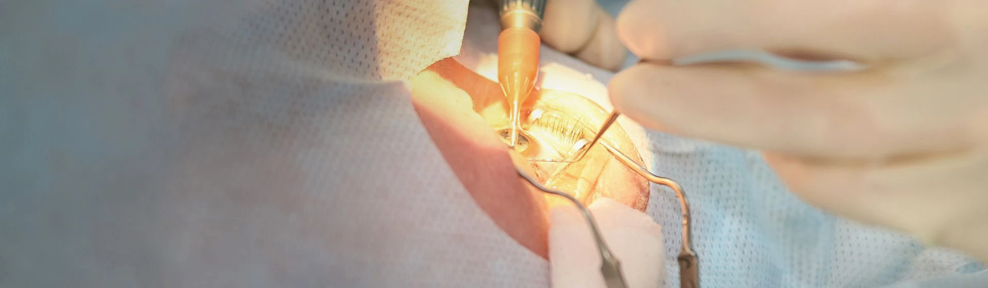 Лечение катаракты в частной клинике Оксфорд Медикал Киев