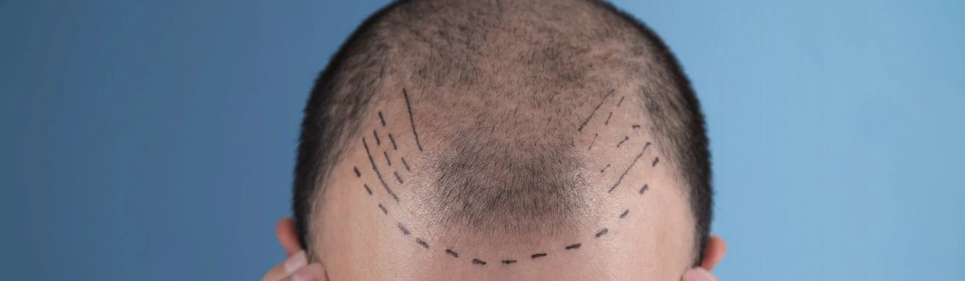 Hair transplantation for men and women in the private clinic Oxford Medical Kiev