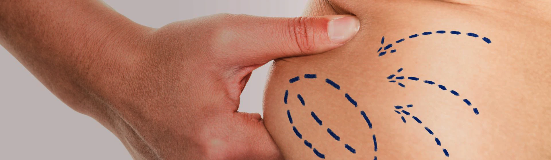 Абдомінопластика (пластика живота) в приватній клініці Оксфорд Медікал Київ