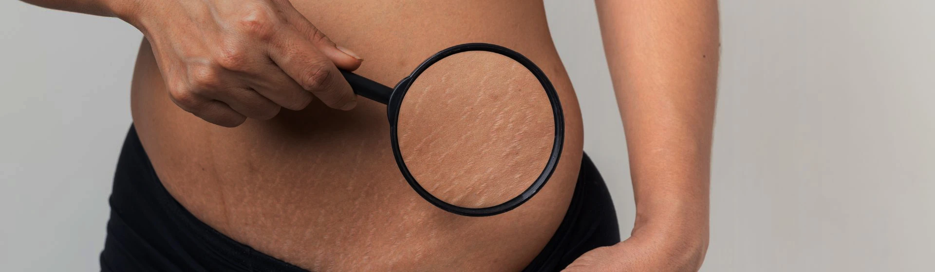 Удаление растяжек в частной клинике Оксфорд Медикал Киев