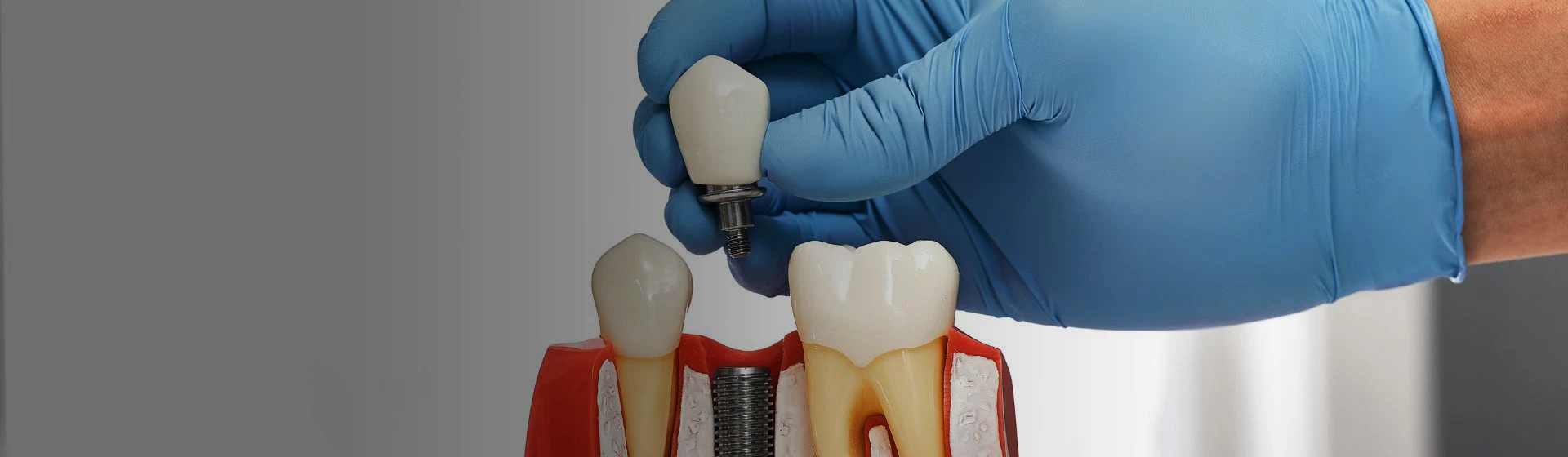 Имплантация зубов в клинике Оксфорд Медикал