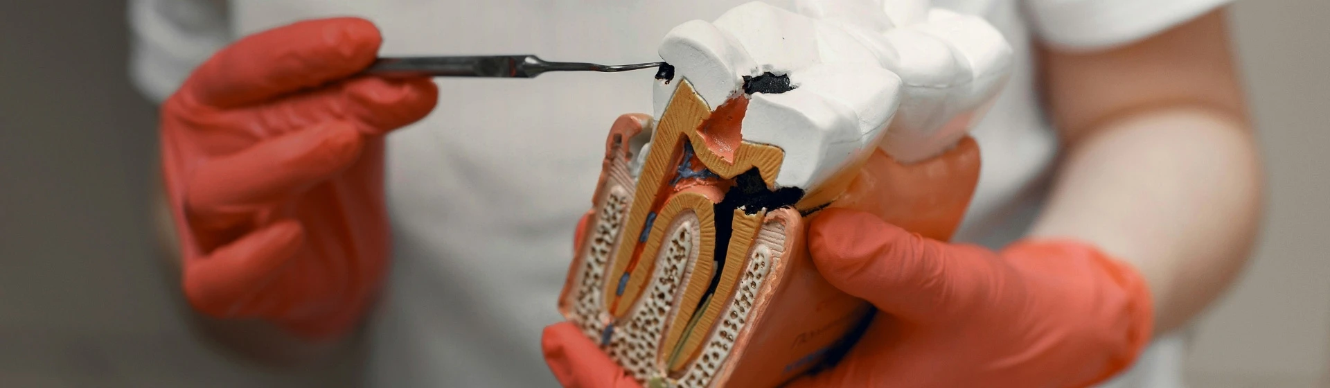 Пломбирование зубов в частной стоматологии Оксфорд Медикал Киев