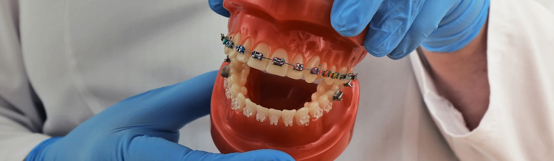 Встановлення брекетів у приватній стоматології Оксфорд Медікал Київ
