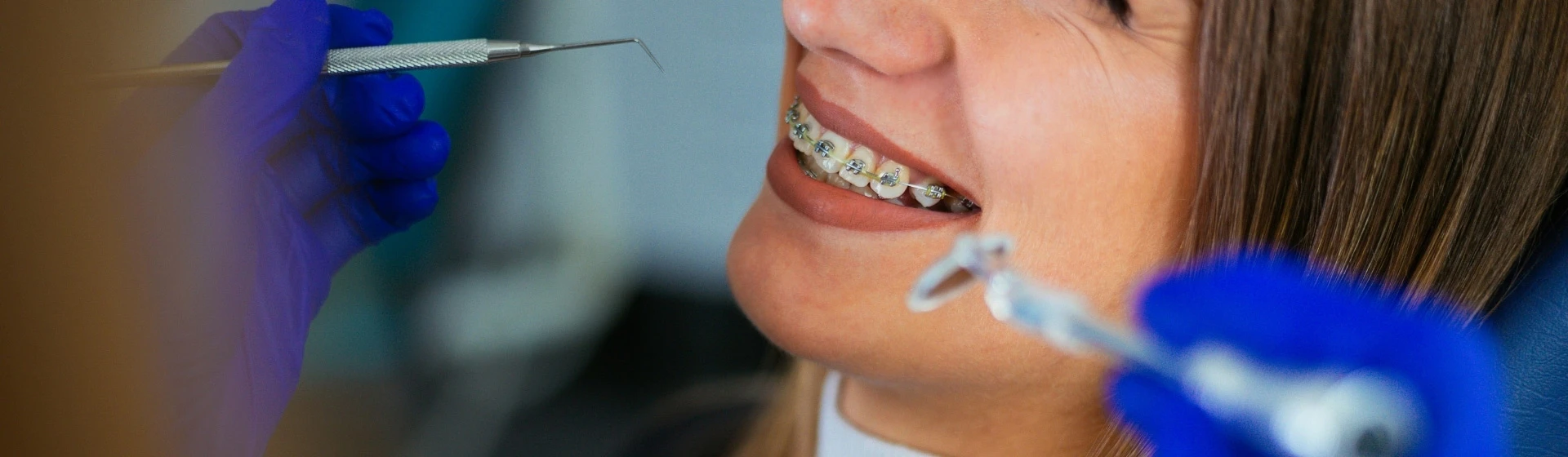 Металлические брекеты в частной стоматологии Оксфорд Медикал Киев