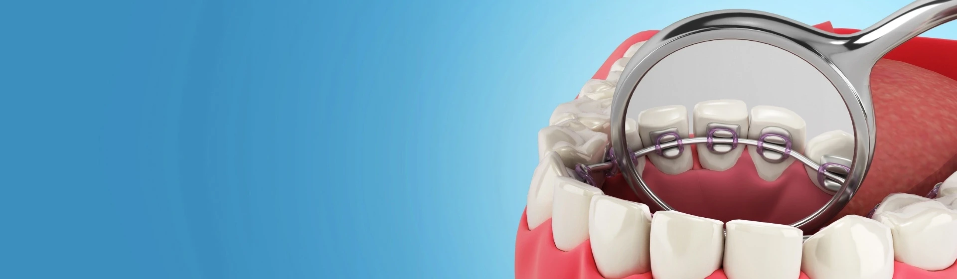 Лингвальные брекеты в частной стоматологии Оксфорд Медикал Киев