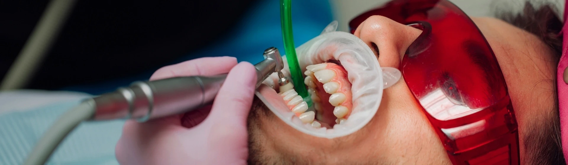 Чистка зубов от камня и налета в частной стоматологии Оксфорд Медикал Киев