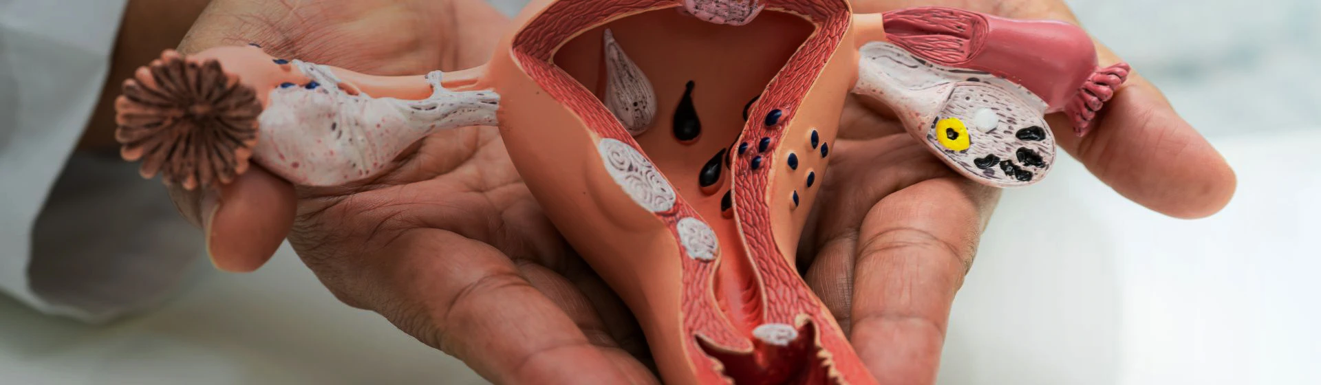 Surgical treatment of endometriosis at the private clinic Oxford Medical Kyiv