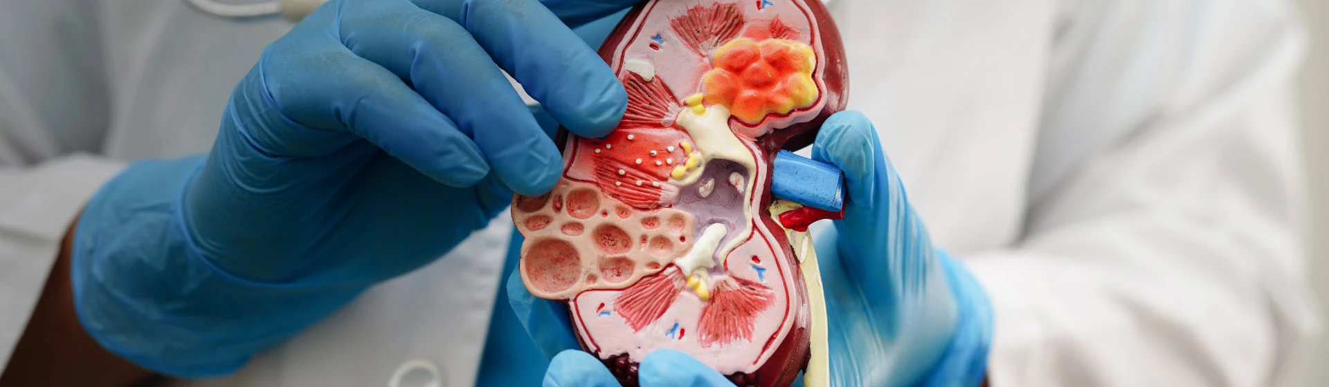 Лікування раку нирки у приватній клініці Оксфорд Медікал Київ