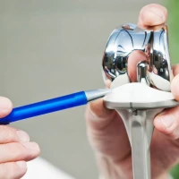 Все о замене суставов: цена, когда, кому и как можно делать эндопротезирование