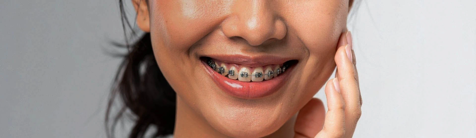 Брекеты Pitts 21 (Питтс 21): цена установки брекет-системы в Киеве | Оксфорд Медикал