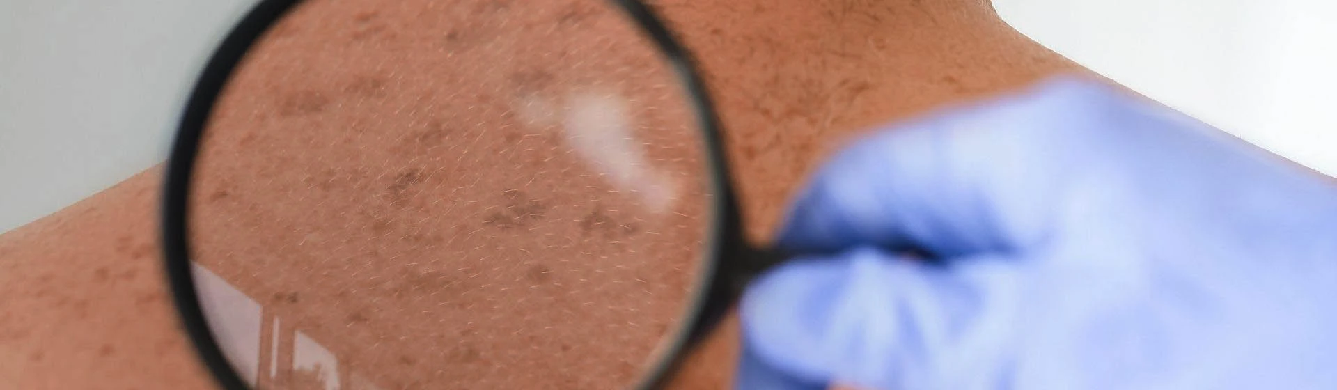 Лечение актинического кератоза в частной клинике Оксфорд Медикал Киев