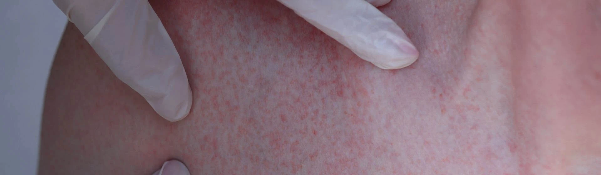 Лечение крапивницы в частной клинике Оксфорд Медикал Киев