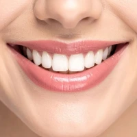 Что такое композитные виниры: преимущества и недостатки