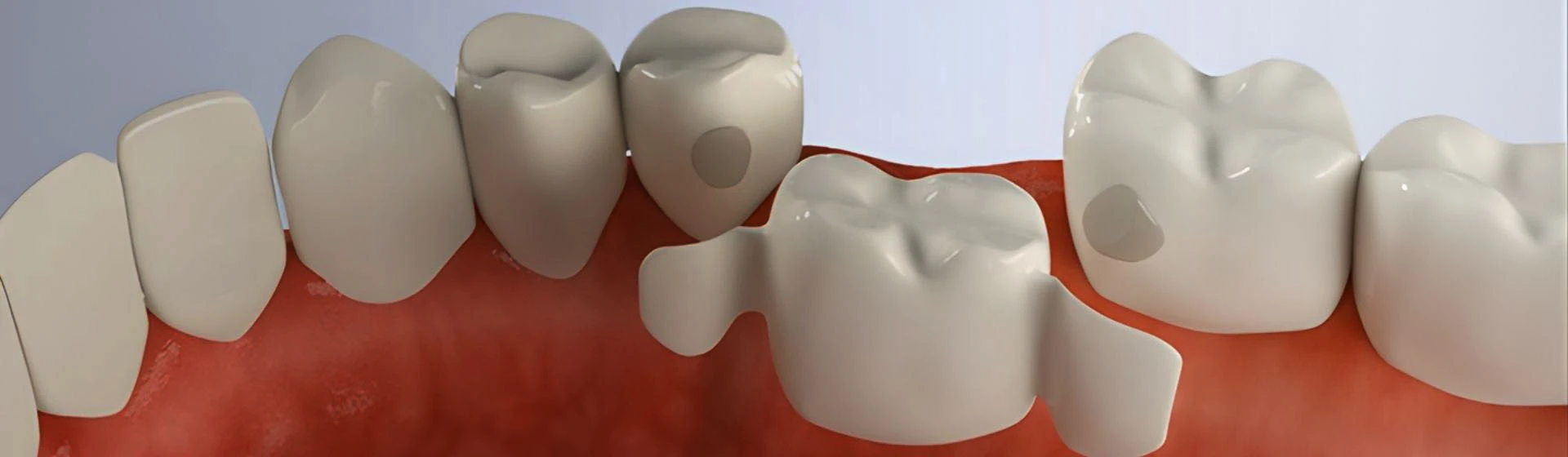 Адгезивний міст