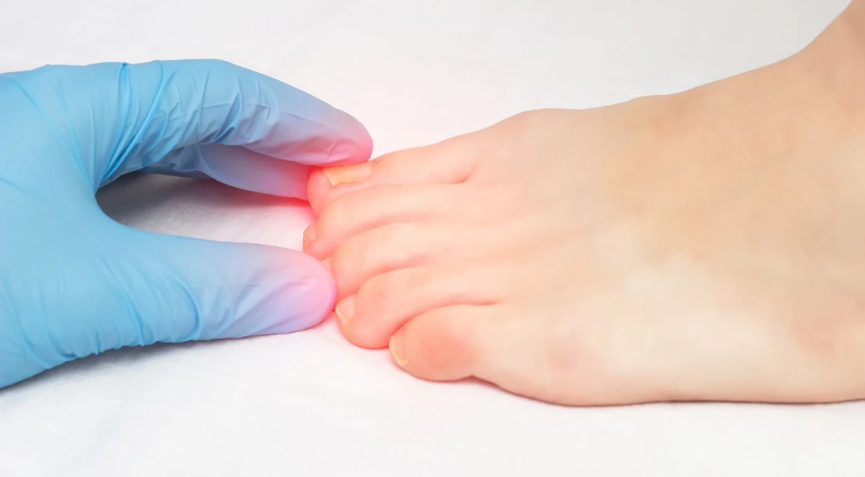 Как определить грибок на ногтях