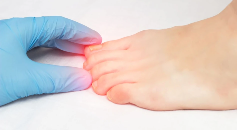 Як визначити грибок на нігтях