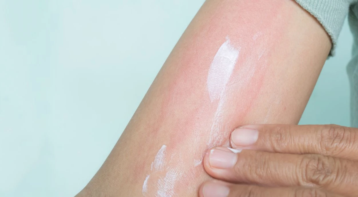 Що таке кропив’янка: як виглядає кропивниця та як її лікувати