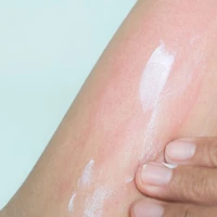 Що таке кропив’янка: як виглядає кропивниця та як її лікувати