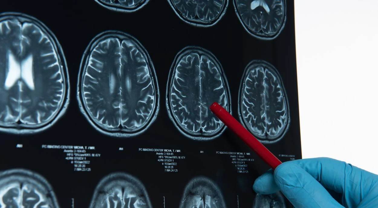 Цереброваскулярные болезни: что нужно знать