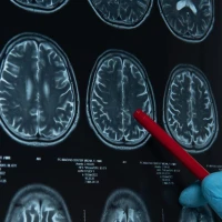 Цереброваскулярные болезни: что нужно знать